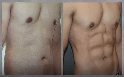before and after vaser lipo Miami