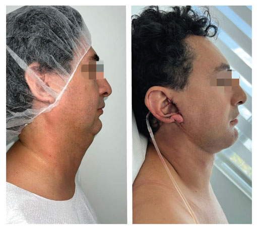 Chin Augmentation Miami