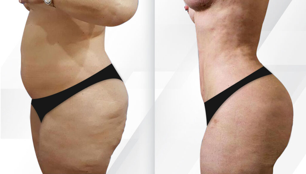 Liposuction Before and After Miami