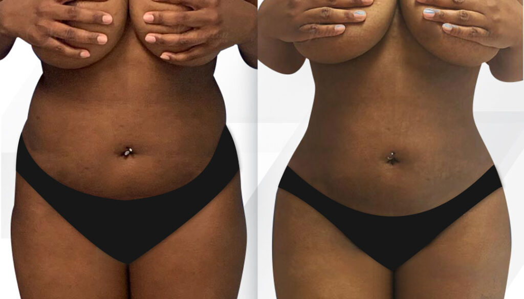 Liposuction Before and After Miami