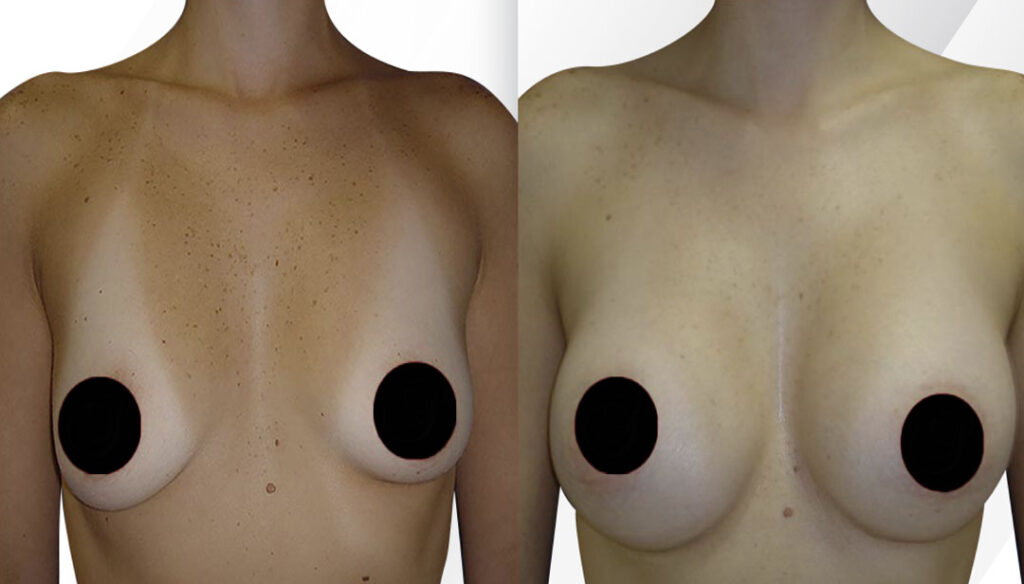 Breast Fat Transfer Before and After Miami