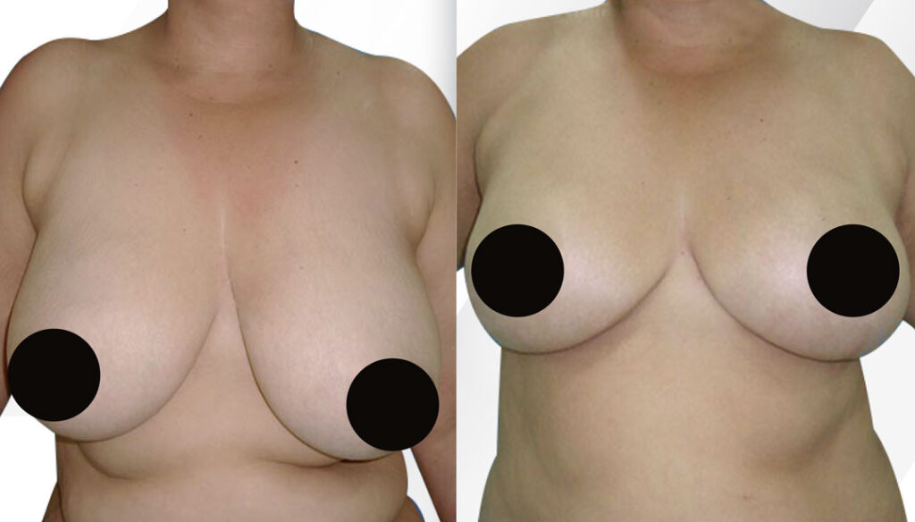 Breast Lift Before and After Miami