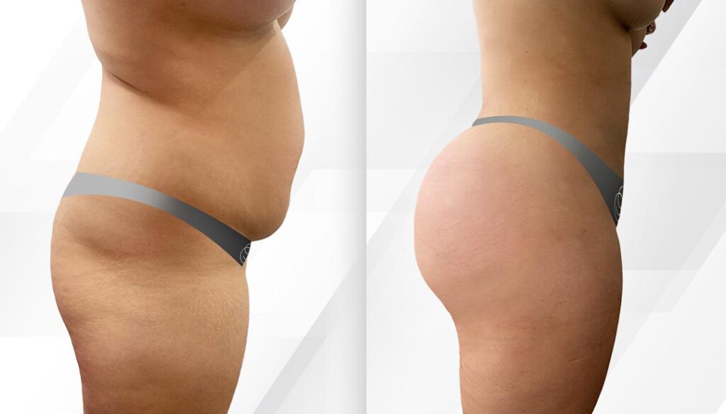 plastic surgery Miami - BBL