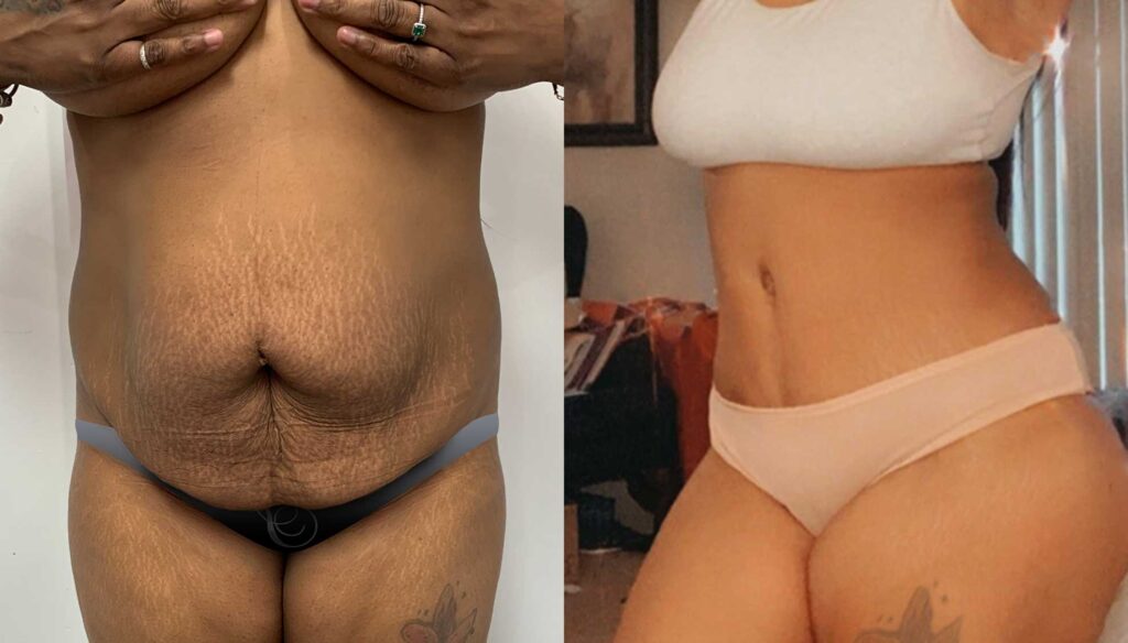 plastic surgery Miami - Tummy Tuck