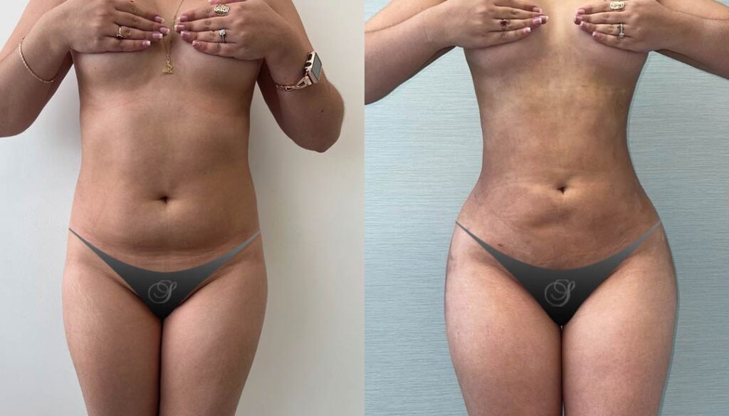 plastic surgery Miami - Lipo 360