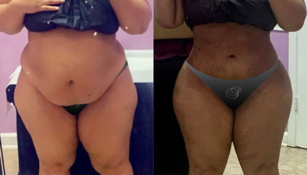 plastic surgery Miami - Lipo 360