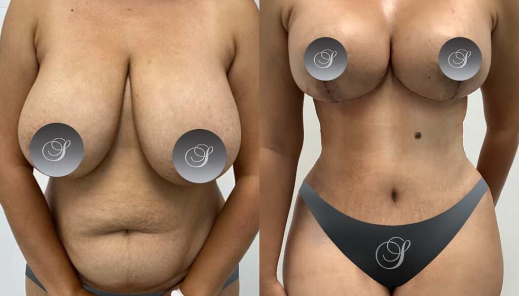 mommy makeover Before and After Miami