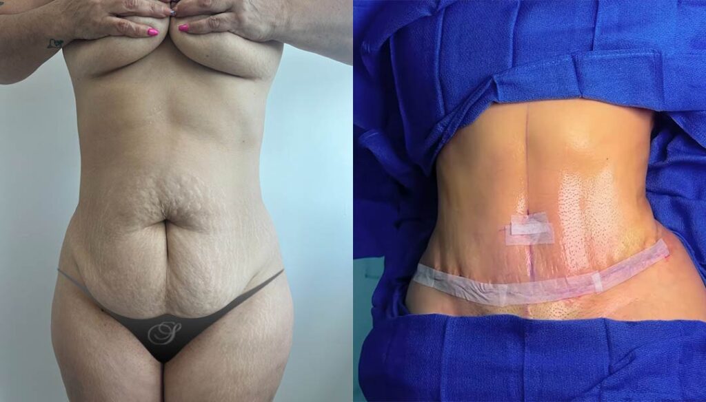plastic surgery Miami - Tummy Tuck