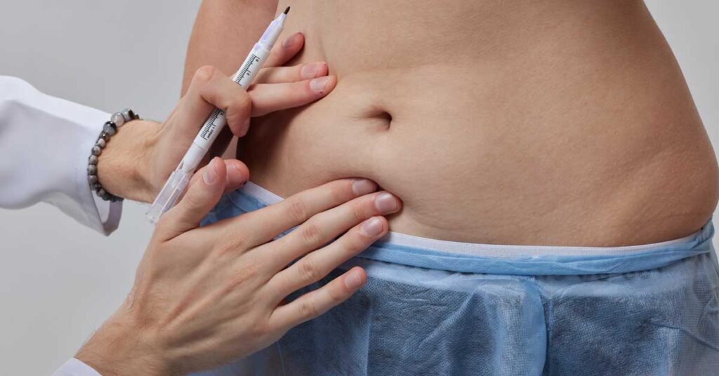 Belly Button Infected After Tummy Tuck