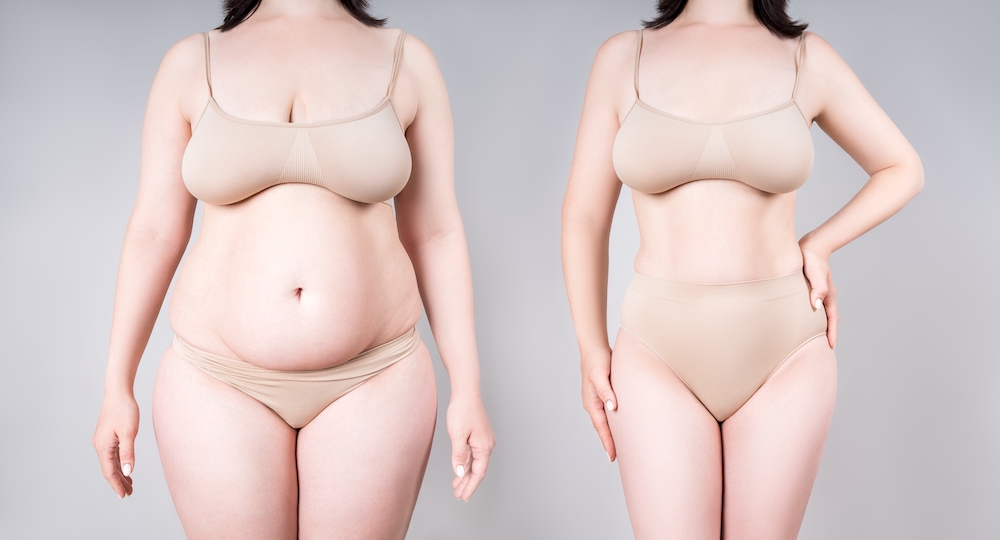 Before and after photos of a woman’s upper body